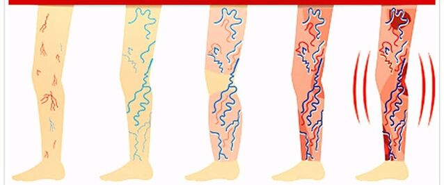 Што да не се прави со проширени вени