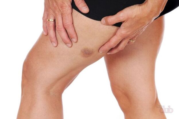 ако пукне вена