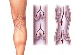 одлив на крв во проширени вени во различни фази на развој на болеста